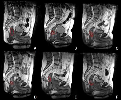 A Predictive Model of 2yDFS During MR-Guided RT Neoadjuvant Chemoradiotherapy in Locally Advanced Rectal Cancer Patients